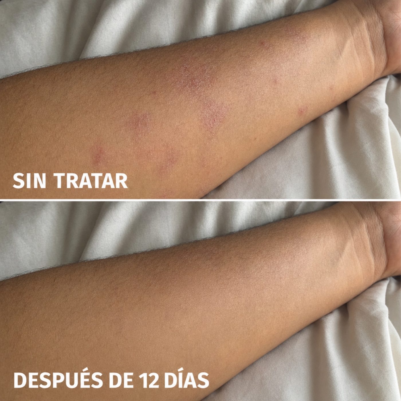 Antebrazo sin tratar vs. después de 12 días