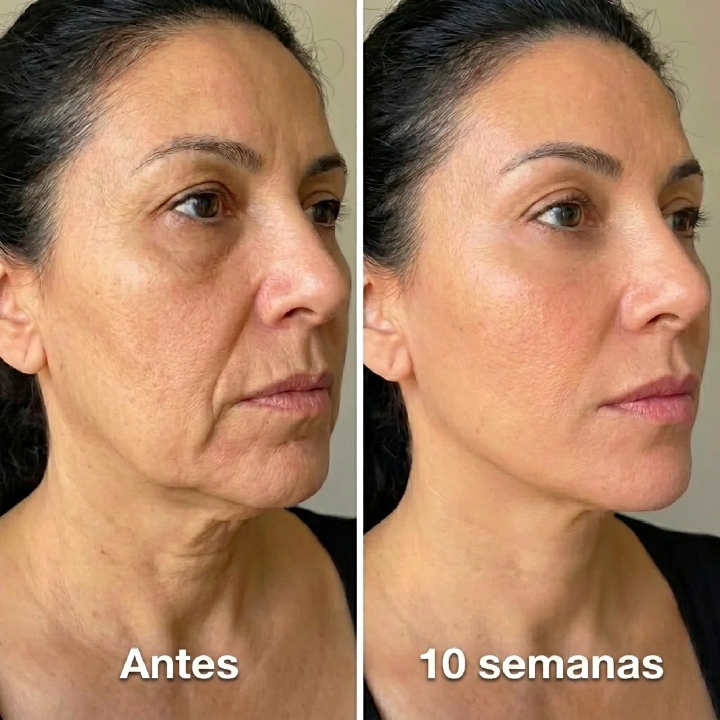 Antes y después — papada más firme en 10 semanas