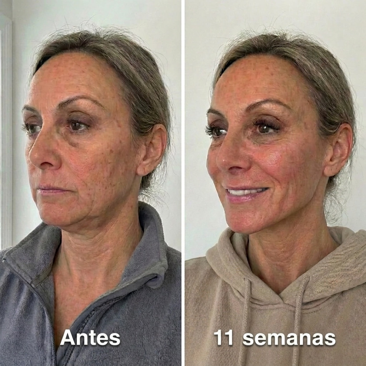 Antes y después — jowls reducidos en 11 semanas