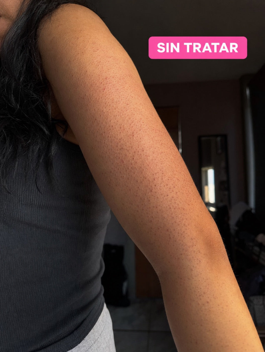 Piel sin tratar con queratosis pilaris