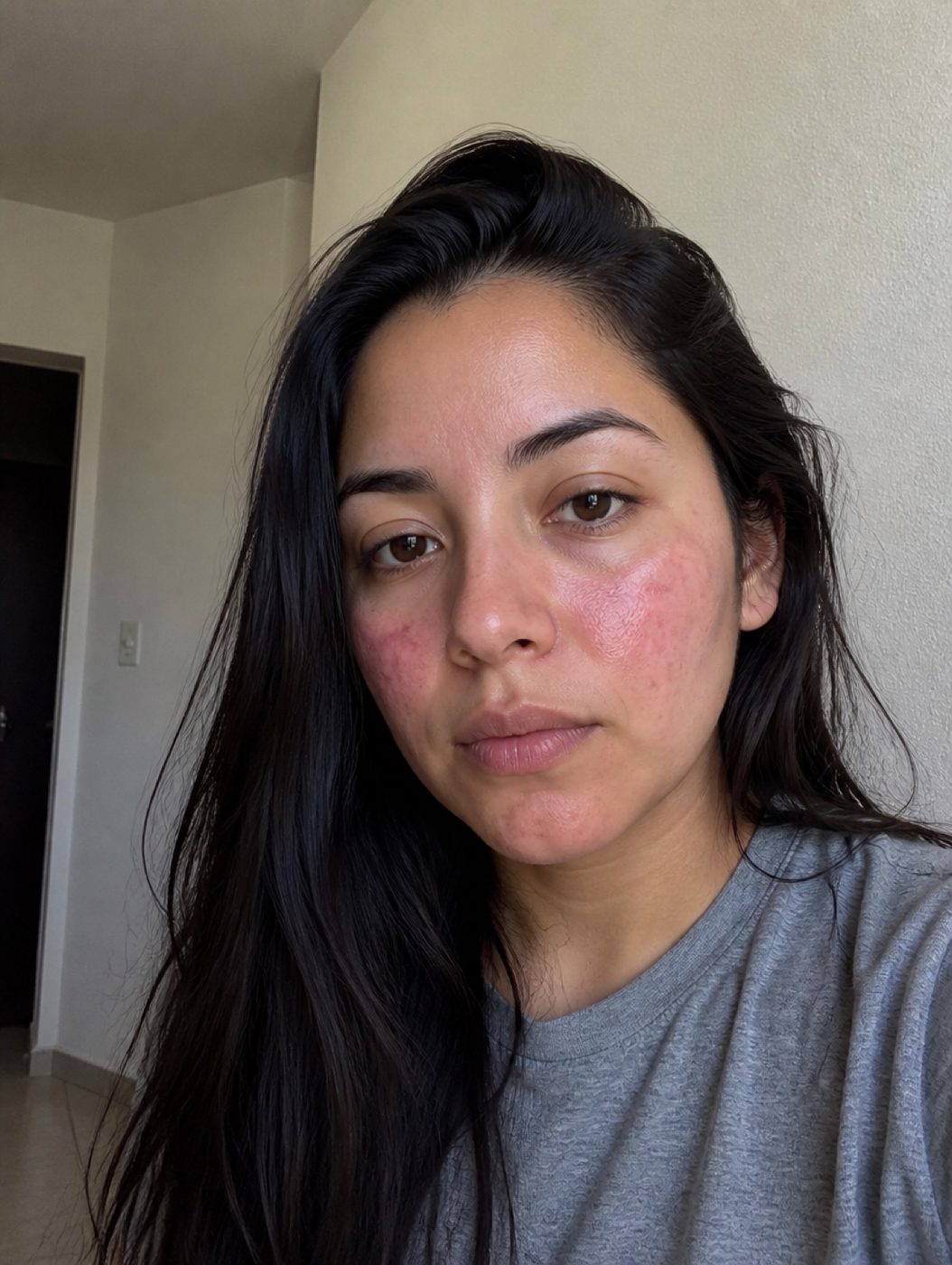 Mujer antes de entender su eczema