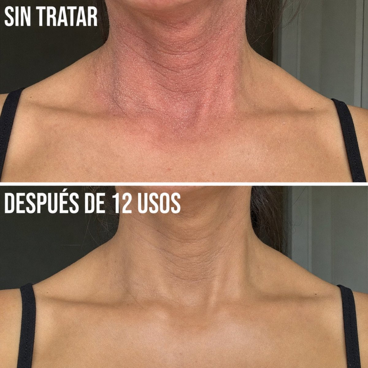 Antes y después — eczema severo en cuello, 12 usos